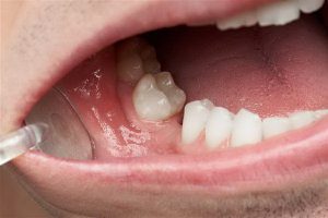 آنچه باید در مورد پر کردن دندان بدانید. | پزشکت
