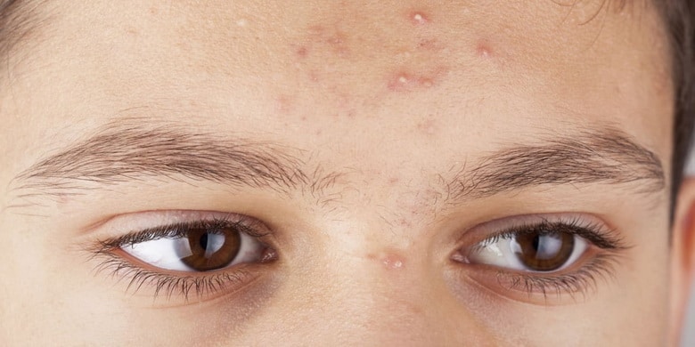 آموکسی سیلین آگمنتین | پزشکت