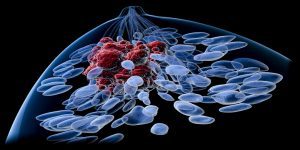 سرطان پستان سه گانه منفی | پزشکت