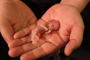 سقط جنین ناقص | پزشکت