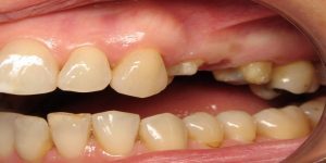 بریج دندان و هر آنچه که باید بدانید. || پزشکت