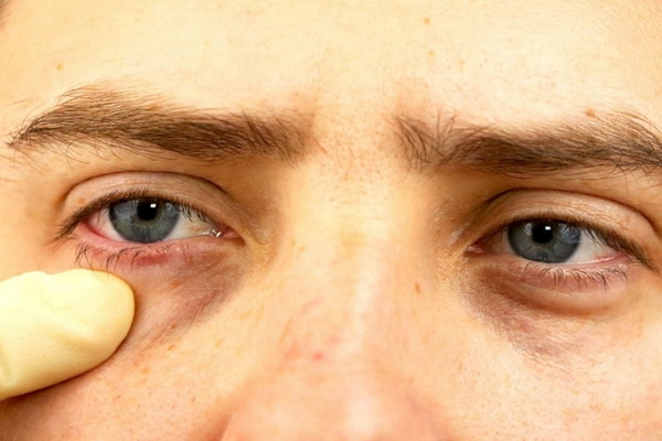 فرورفتگی چشم از علل تا درمان | پزشکت
