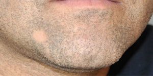 ریزش موی صورت در مردان | پزشکت