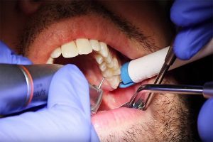 آنچه باید در مورد پر کردن دندان بدانید. | پزشکت