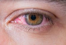 شایع ترین علل سوزش چشم | پزشکت