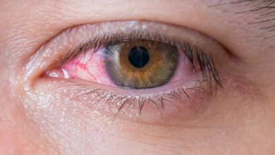 شایع ترین علل سوزش چشم | پزشکت