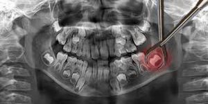 دندان عقل و مشکلات آن | پزشکت