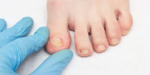 فرو رفتن ناخن پا | پزشکت