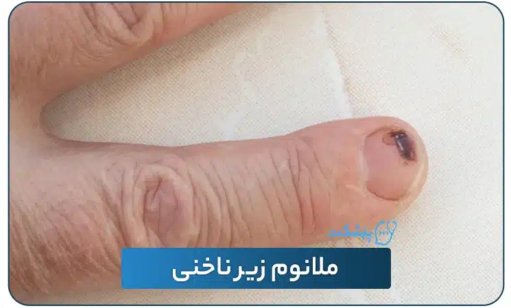 ملانوم زیر ناخنی | پزشکت