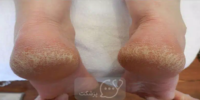 ترک خوردگی پاشنه پا || پزشکت