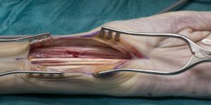 جراحی تونل کارپال یا عصب دست || پزشکت