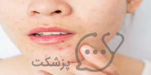 کلیندامایسین از کاربرد تا عوارض || پزشکت