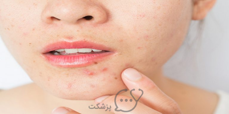 کلیندامایسین از کاربرد تا عوارض || پزشکت