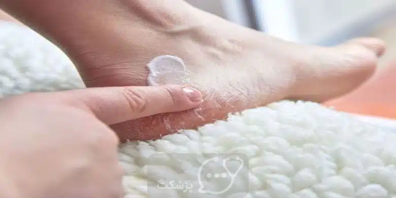 ترک خوردگی پاشنه پا || پزشکت