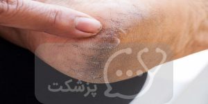 ترک خوردگی پاشنه پا || پزشکت