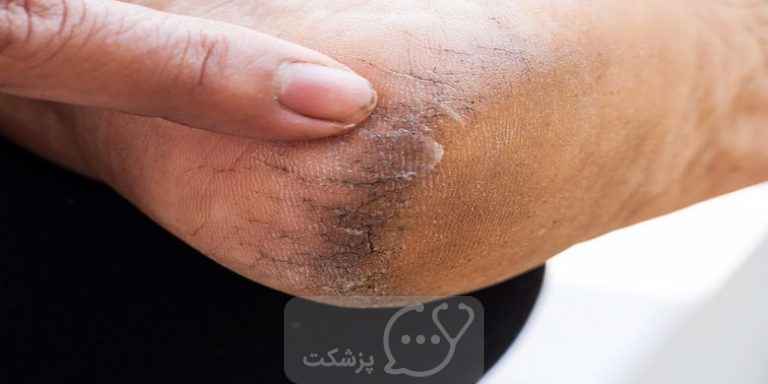 ترک خوردگی پاشنه پا || پزشکت