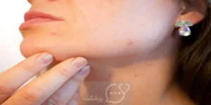 عکس توده زیر چانه || پزشکت