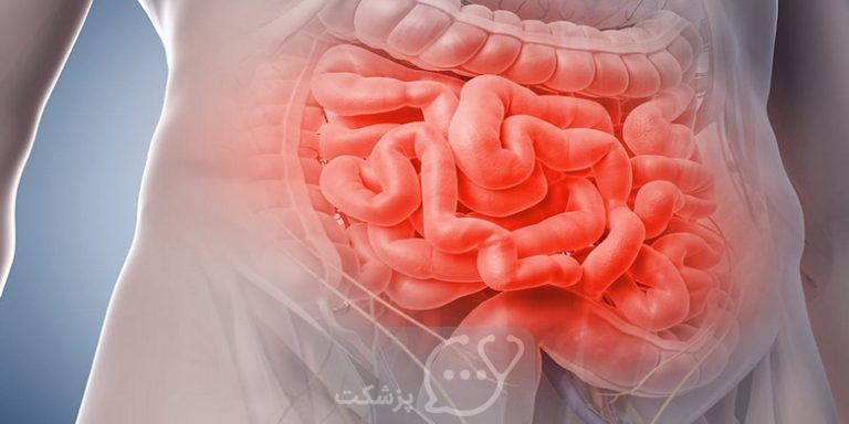 بیماری کرون اطراف مقعد چیست؟ || پزشکت