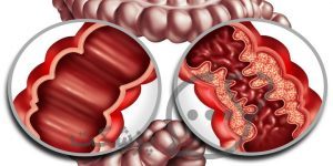 انواع بیماری کرون را بشناسید. || پزشکت