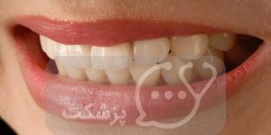 خمیر دندان ضد حساسیت چیست؟ || پزشکت