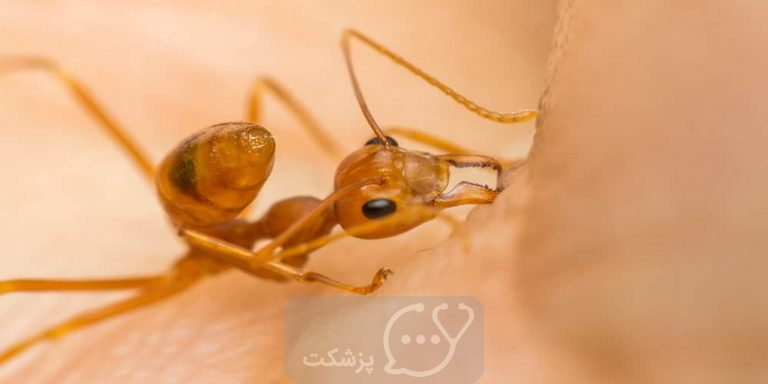 نیش مورچه قرمز: علائم، درمان و عوارض || پزشکت