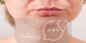 علت برآمدگی سفید روی لب چیست؟ || پزشکت