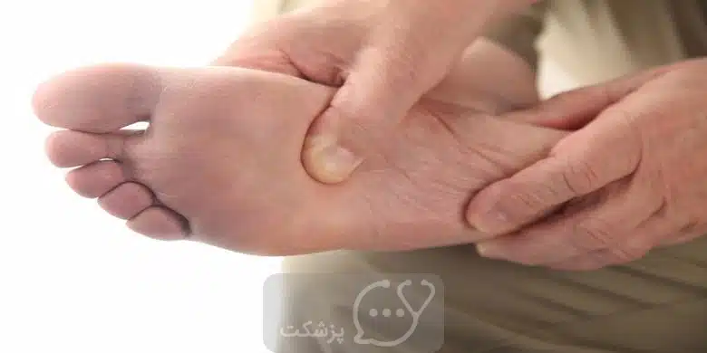 ترک خوردگی پاشنه پا || پزشکت