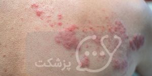 درمان خانگی زونا || پزشکت