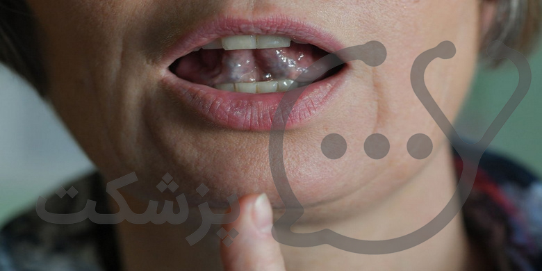 چگونه لکنت زبان را متوقف کنیم؟ || پزشکت