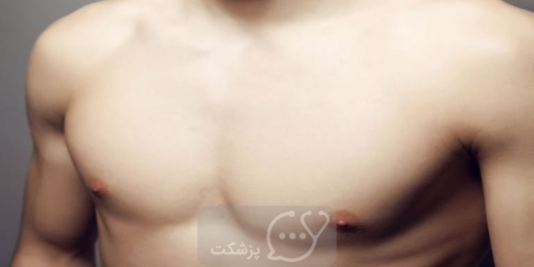 ژنیکوماستی ناشی از دارو || پزشکت