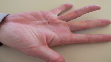 خار استخوانی در دست چگونه درمان می شود؟ || پزشکت