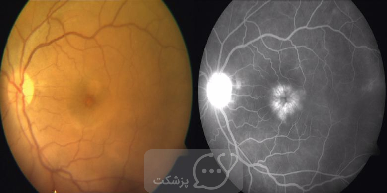 مایع اضافی در چشم چیست؟ || پزشکت