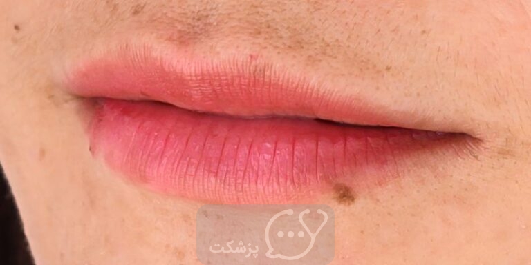 لکه های سیاه روی لب نشان دهنده چیست؟ || پزشکت