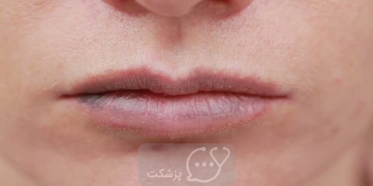 کبودی لب ها یا تغییر رنگ آنها نشان دهنده چیست؟ || پزشکت