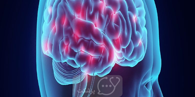 تومور مغزی و تشنج || آیا تومور مغزی باعث تشنج می شود یا بالعکس؟ || پزشکت