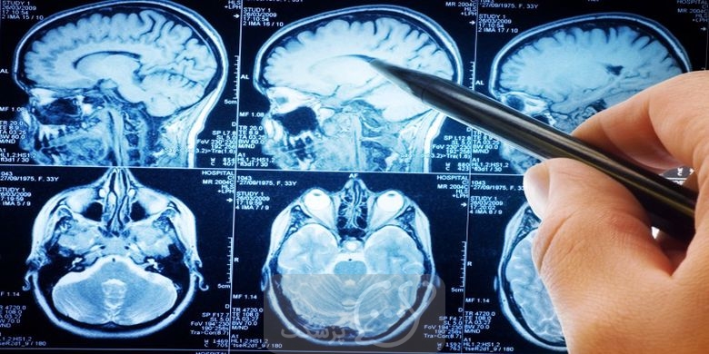 تومور مغزی و تشنج || آیا تومور مغزی باعث تشنج می شود یا بالعکس؟ || پزشکت