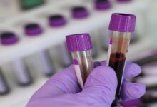 آزمایش خون بیماری لایم چیست و نتایج غیرعادی آن چه چیزی را نشان می دهد؟ || پزشکت