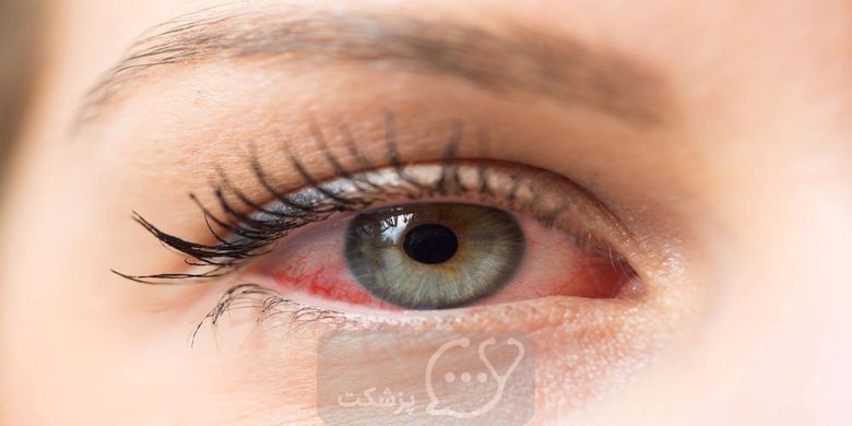 خشکی چشم پس از لیزیک و راه های درمانی آن || پزشکت