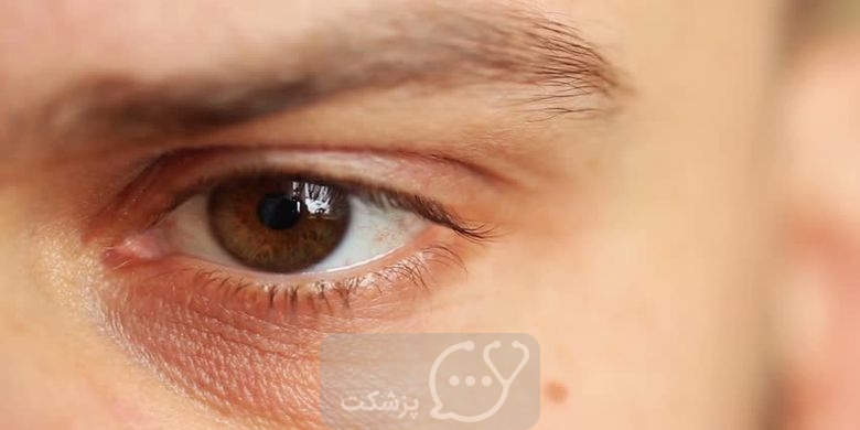 16 درمان خانگی موثر برای خارش چشم که نمی دانید! || پزشکت