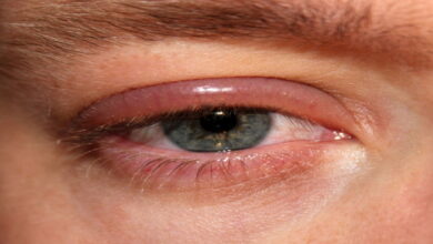 التهاب چشم و انواع مختلف آن || پزشکت