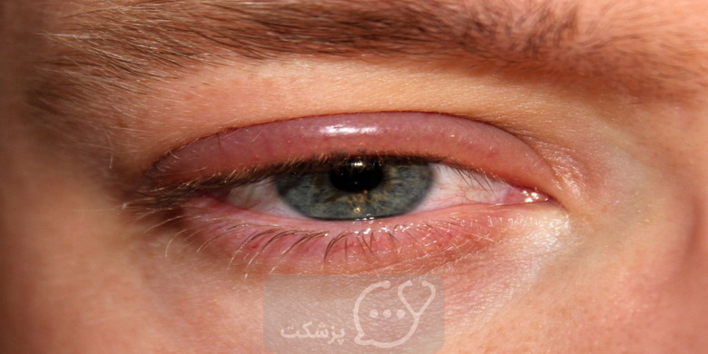 التهاب چشم و انواع مختلف آن || پزشکت
