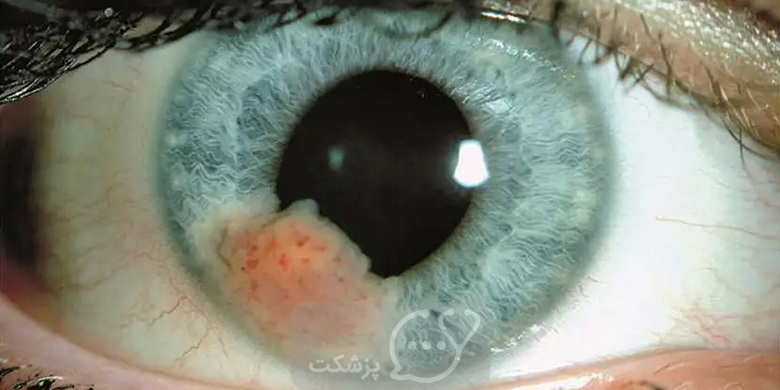 تومورهای چشمی را بشناسید. || پزشکت