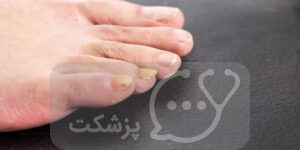 ضخیم شدن ناخن های پا | پزشکت