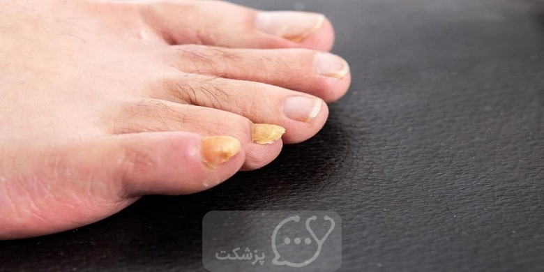 علت ضخیم شدن ناخن های پا چیست؟ || پزشکت