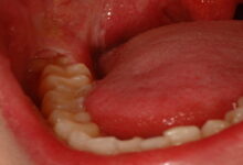 عفونت دندان عقل || پزشکت