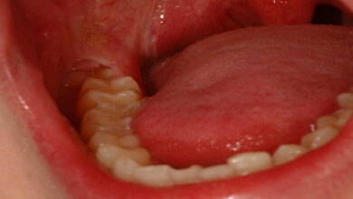 عفونت دندان عقل || پزشکت