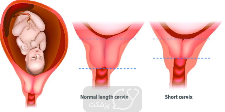 کوتاهی دهانه رحم || پزشکت