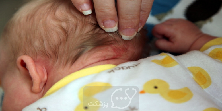 درمان بثورات گردن در نوزاد