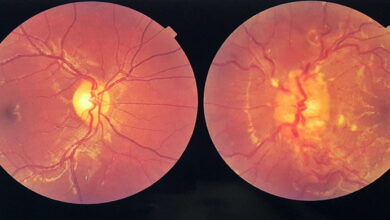 ادم پاپی یا تورم عصب بینایی چیست؟ || پزشکت