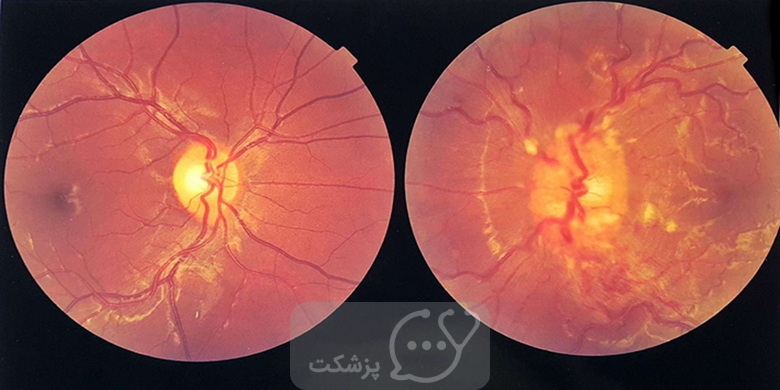 ادم پاپی یا تورم عصب بینایی چیست؟ || پزشکت